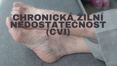 Chronická žilová nedostatočnosť (CVI): Príznaky, príčiny, liečba a prevencia | ARNO-obuv.sk - obuv s tradíciou
